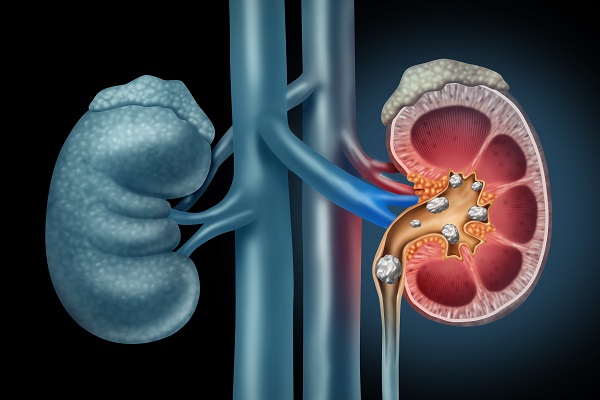 ayurvedic kidney treatment